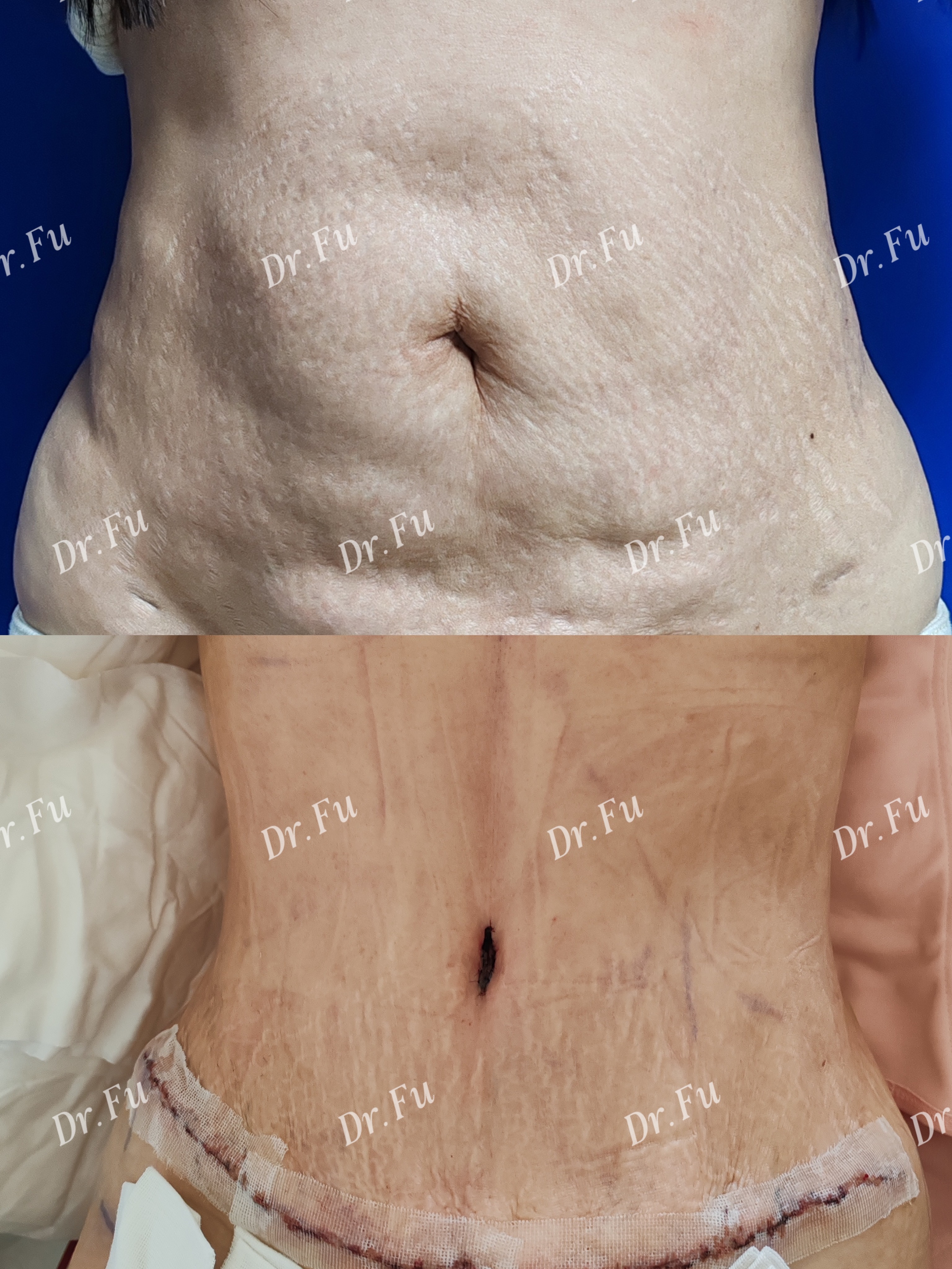 Abdominoplasty Case 6